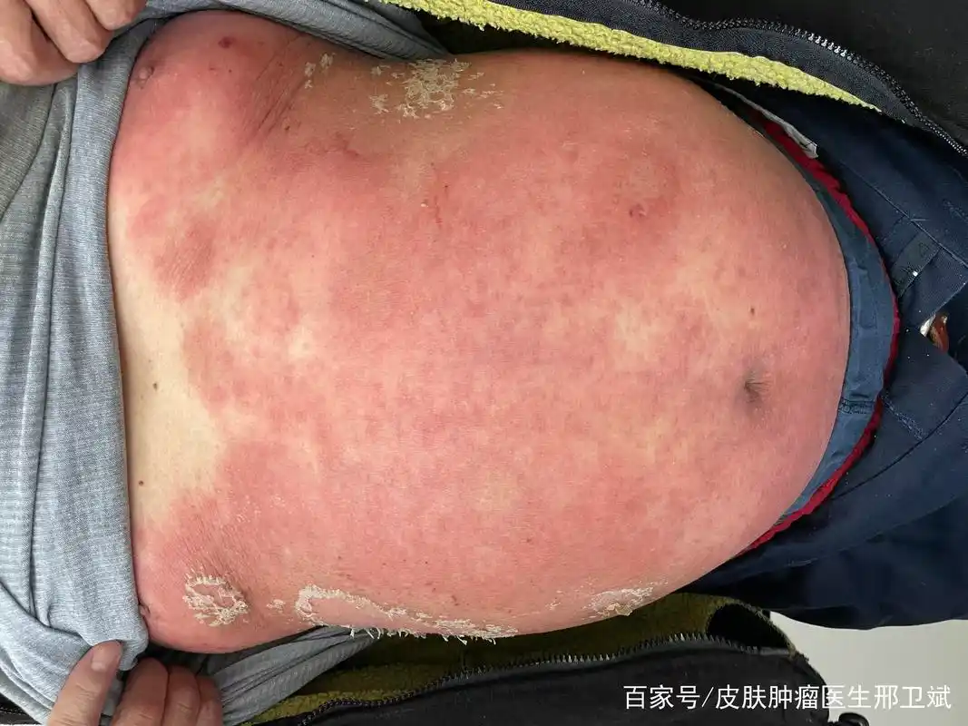 全身起红斑是怎么回事儿?