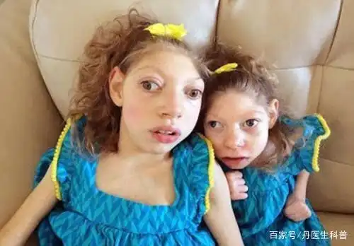 导语:马方综合征又被我们称之为马凡综合征,肢体细长症,这是一种先天