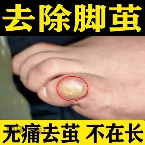 茧子去除  去脚底老茧死皮软化剂厚脚垫胼胝祛鸡眼药上手关节茧子去除