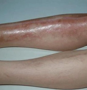 放射性骨髓炎的危害有哪些方面