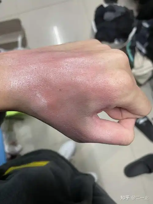 手被开水(100度)烫伤恢复全过程(ps:附带我的做法以及正确处理方法)