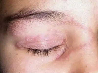 单纯疱疹病毒性睑皮炎症状图片