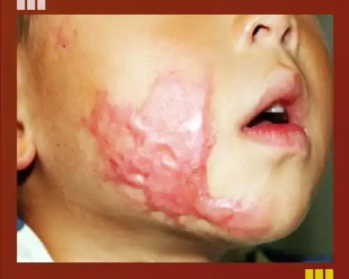 烧烫伤预防意识的缺乏 导致我国儿童烧烫伤高发