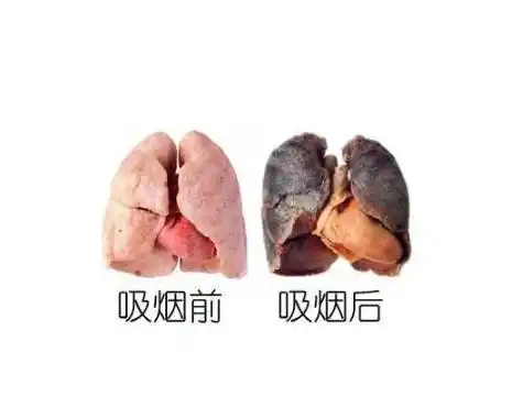 吸烟者的肺吓死了润和津露可以帮助你