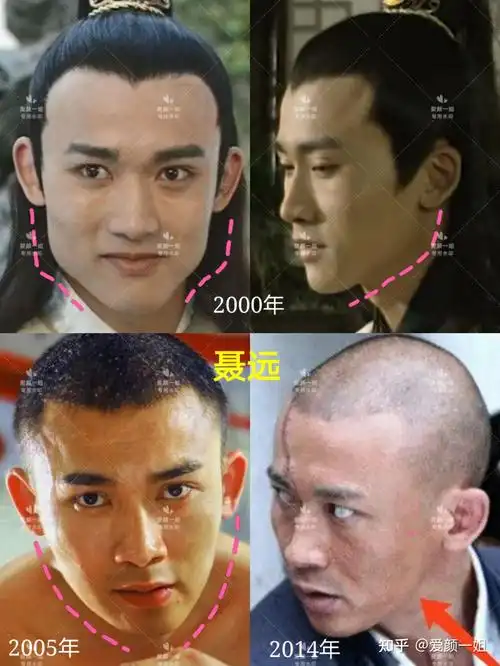 图3聂远劈外板主要解决的是下颌体厚度,减小正面下半脸型的宽度