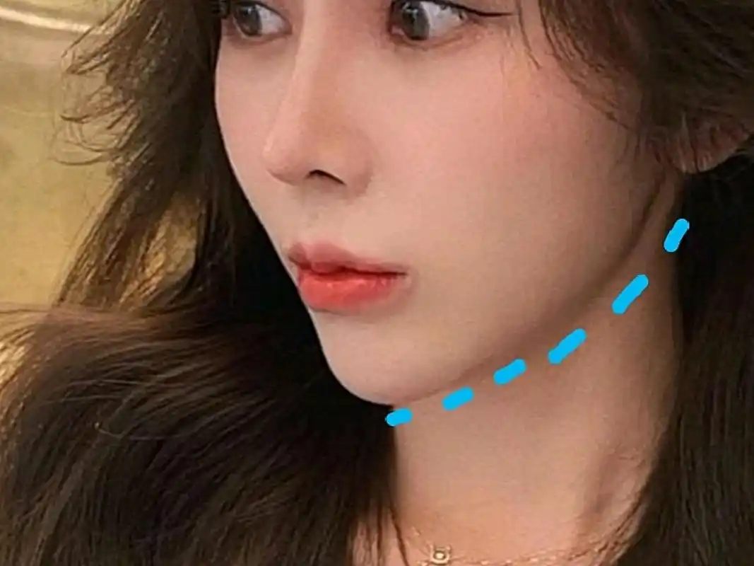 下颌缘不清晰怎么办?有效塑造下颌线的医美项目有什么?