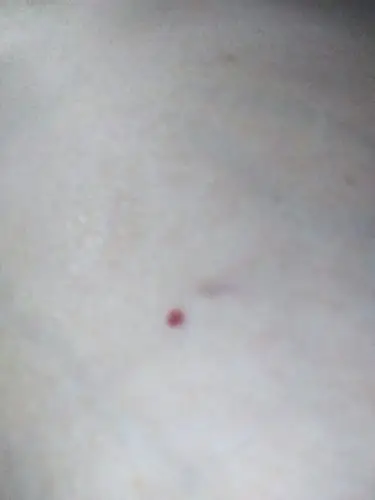 (主要长在胸,腹部)血痣越大越多,肝的代谢功能越差,容易血脂过高