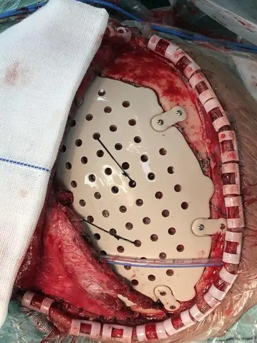 开颅术后骨瓣凹陷整形(左侧额颞顶)_颅骨修补术_颅骨修补术治疗介绍