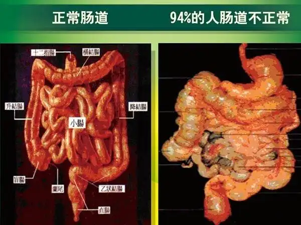 便秘首选益生菌的原因