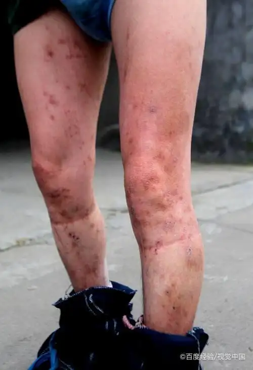 被红火蚁咬后有哪些症状