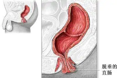 肛门息肉是怎么一回事