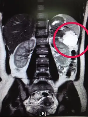 怀孕了,眼看着孕期已经3个月,但b超检查却怎么也找不到子宫里的胎儿