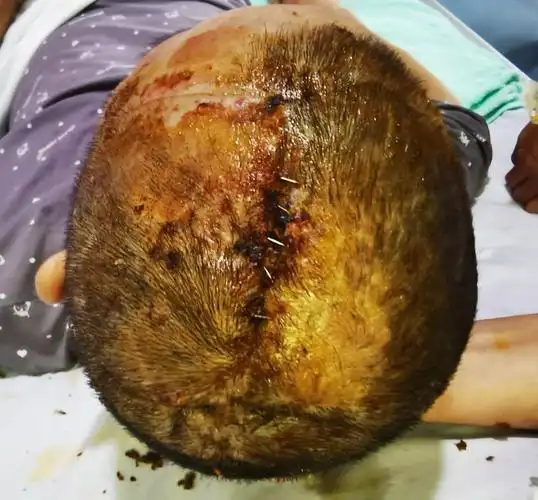 5cm左右,局部皮肤已经明显缺血坏死,在当地医院已行去骨瓣减压手术