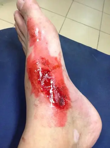 腿脚多处受伤.被送往中山医院.简单涂