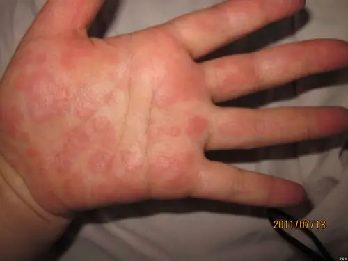 身上多发部位红斑,痒痛,帮忙看看,谢谢! - 皮肤及性传播疾病讨论版 -