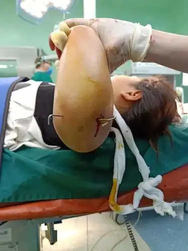 开刀无刀口微创手术治疗儿童髁上骨折