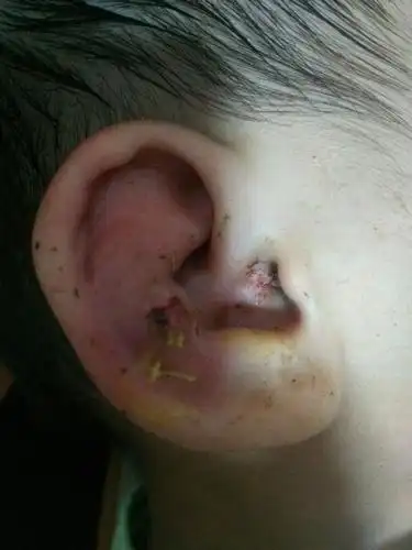 小孩耳郭长了个大脓包耳朵红肿要怎么处理_百度宝宝知道