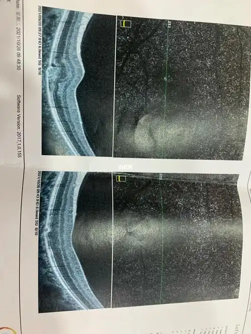 脉络膜新生血管