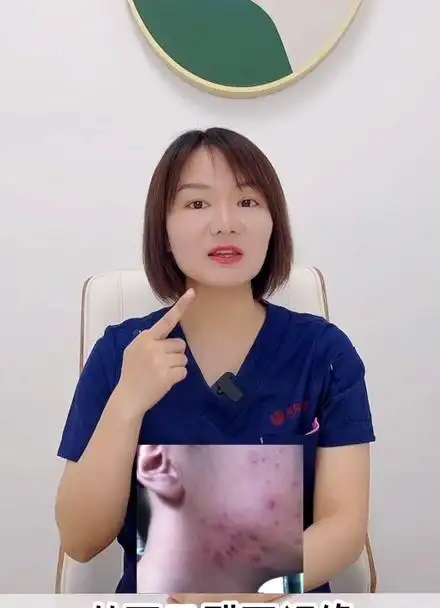 下巴反复长痘怎么办?-徐薇医生