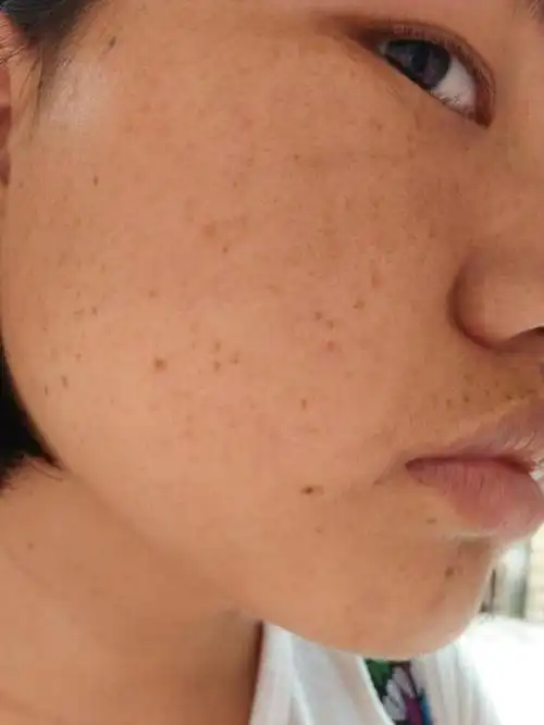 21岁就脸上全都是斑.怎么办?