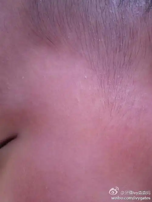 宝宝脸上两边各长了这个白色的凸出的东西 不是脂肪粒 请问这是什么?