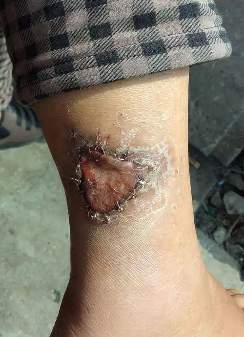 植皮手术两个星期大家帮我看看怎么样