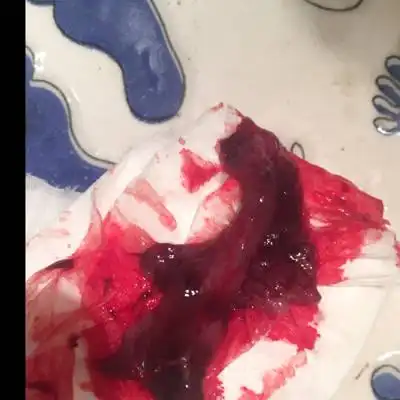 我以前有一个同事怀孕的时候一动就见红,医生建议流产时就是让他留意