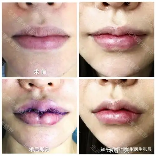 嘴唇毕竟是少数,对于想拥有好看唇形的宝宝们可以通过唇部整形手术