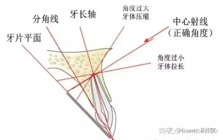 当胶片放入口内与被照牙牙冠及相应牙槽突紧贴时,胶片通常都会与被照