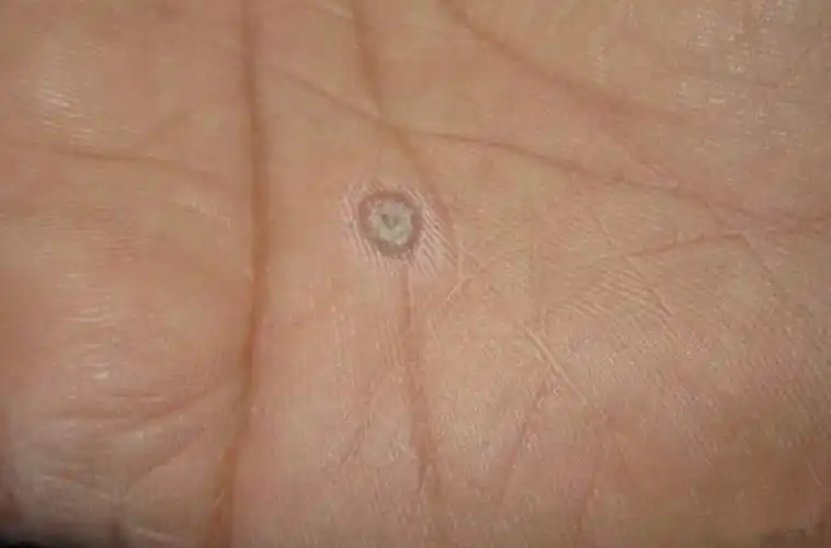 脚上的鸡眼图片