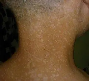 色素减退的汗斑