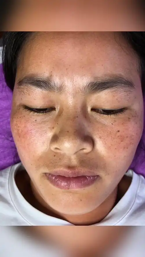 这祛斑效果有没有震惊到 你满脸斑斑点点的心理8915 来现场斑掉