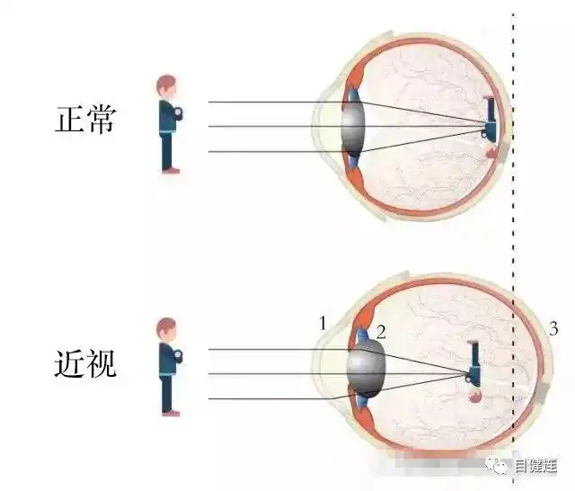 孕妇要像宝宝一样爱护眼睛