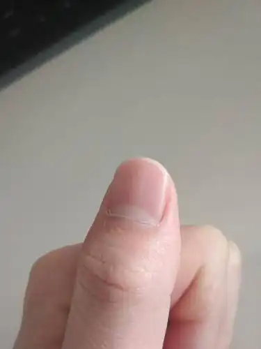 两个手的大拇指指甲里面都有一条白色的竖线,这是哪里出问题了?