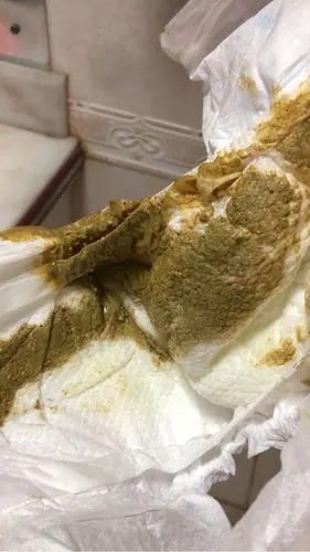 请问宝妈,这样的大便正常吗?有图慎入