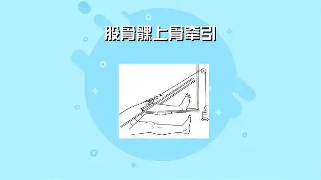 股骨髁上骨牵引:一种牵引技术-健康视频-搜狐视频