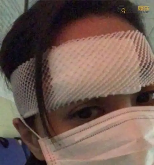 阿娇头部受伤缝十针 照片曝光伤口触目惊心让人心疼不已