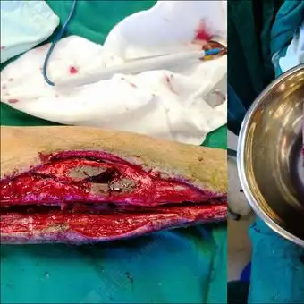 胫骨骨髓炎清创后骨缺损治疗