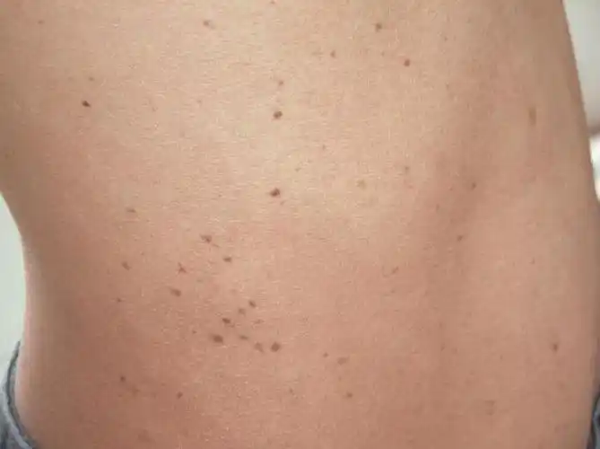 现病史:2年来躯干出现较多棕色,褐色斑点及隆起性皮疹,逐渐增多,近来