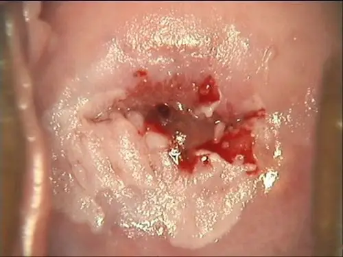 妇科宫颈糜烂图片_有来医生