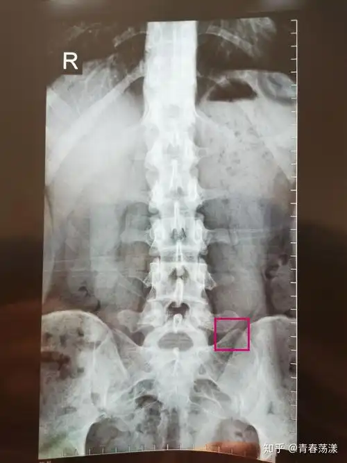 轻度脊柱侧弯 腰疼,我还年轻有办法恢复吗