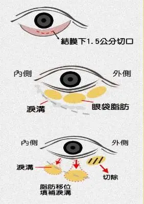 关于去眼袋手术的小秘密