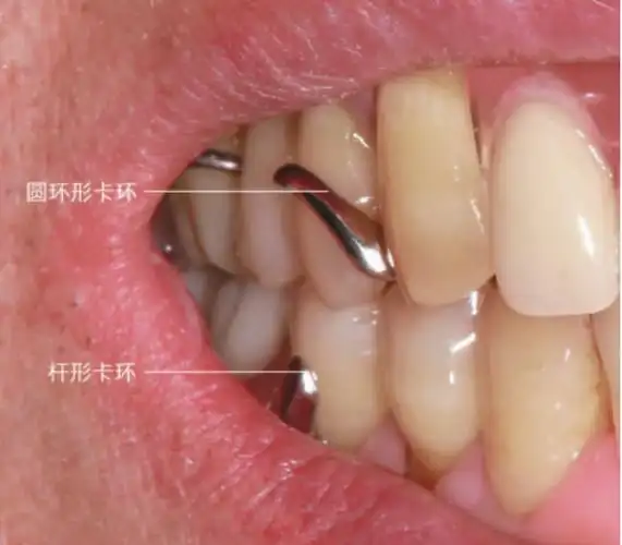 图9 杆形卡环金属暴露较少根据基牙导线位置,杆形