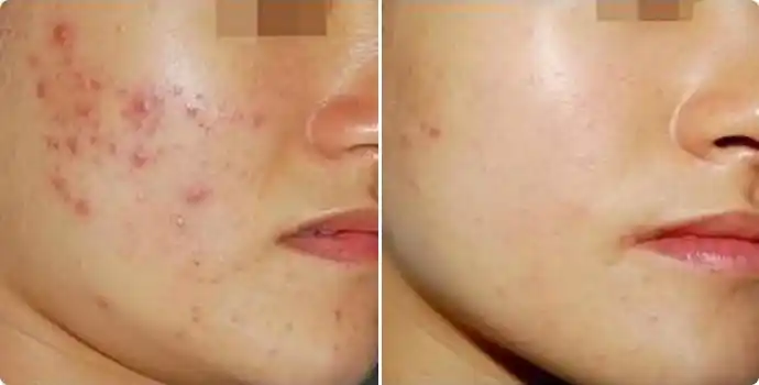 像素激光前后对比图像素激光效果图像素激光前后对比照片