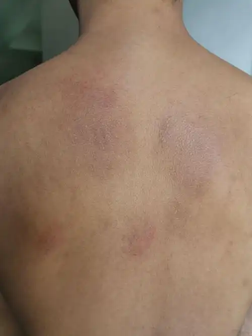 医生你好我背上有暗褐色斑块痒最近似乎有扩散转移的迹象