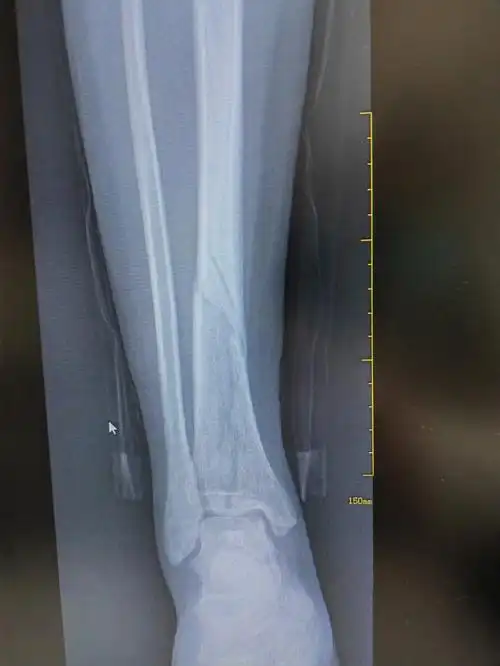 胫骨骨折五个月复查