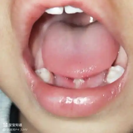 1岁半的男宝宝舌头下面长了像肉一样的东西有人知道么着急
