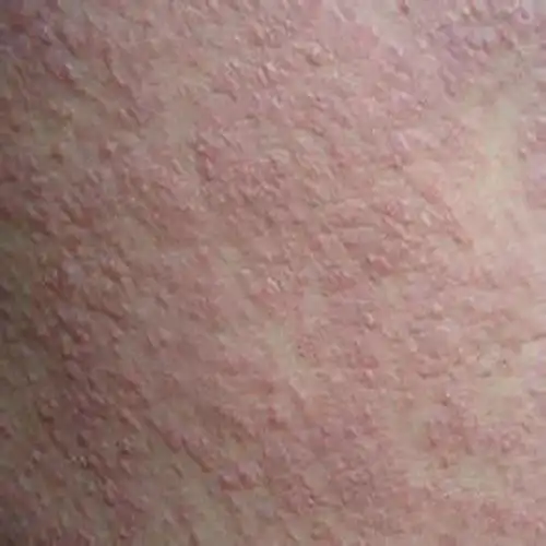 丘疹湿疹症状图片_有来医生