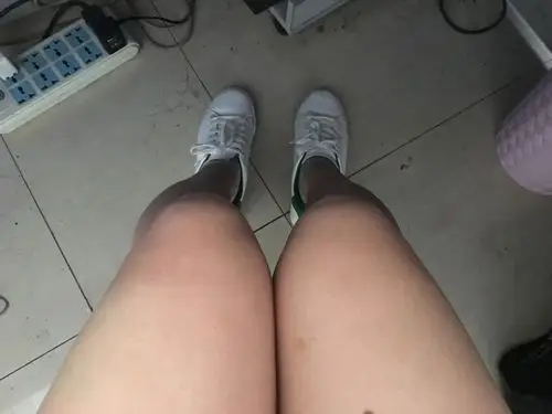 大腿靠膝盖外侧肉突出,有肌肉有脂肪,想知道减脂后能不能解决线条问题