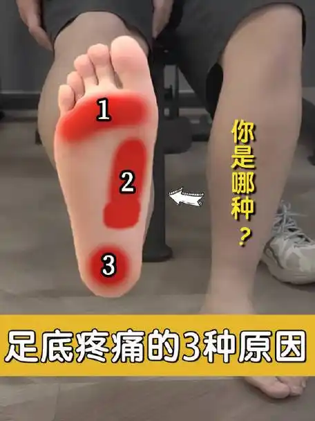 足底筋膜炎##健闻登顶计划##运动康复